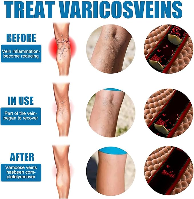 Varicose Veins Treatment